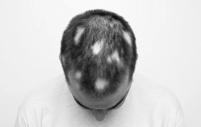 Alopecia Hair Loss